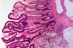 A histopathological stain of an adenocarcinoma of the colon