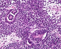 Micrograph of a Wilms tumor stained with hematoxylin and eosin.