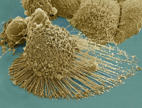 SEM of apoptotic HeLa Cells 