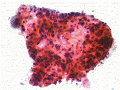 Micrograph of squamous carcinoma, a type of non-small-cell lung cancer