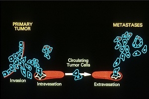 Cartoon model of metastasis