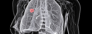 3D image of non-small cell lung tumor within a body