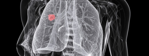 Non-small Cell Lung Cancer.