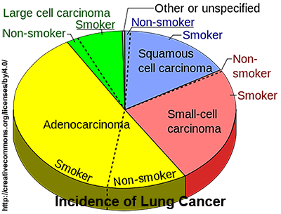 Pie chart of the incidence of lung cancer types.
