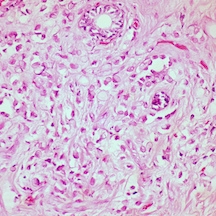 Image of Breast Cancer tissue