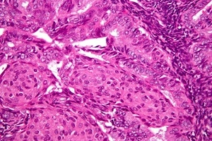 Micrograph of endometrioid endometrial adenocarcinoma, by Nephron via Wikimedia Commons