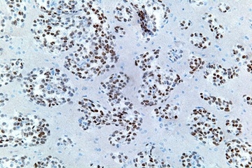 Image of Nuclei-stained lung adenocarcinoma