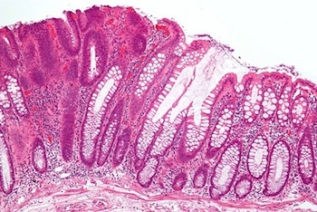H & E stained micrograph of an adenoma in the colon from WIkimedia Commons via Nephron