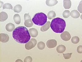 Image of B-acute lymphoblastic leukemia (ALL) in Wright stained peripheral blood from a child. Image photographed by Christaras A and licensed via Wikimedia Commons. Links to publication page.