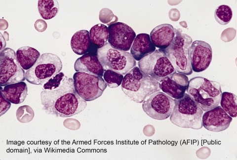 Acute Myeloid Leukemia 