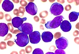 Derivative of a photo of a Wright's stained bone marrow aspirate smear of patient with precursor B-cell acute lymphoblastic leukemia
