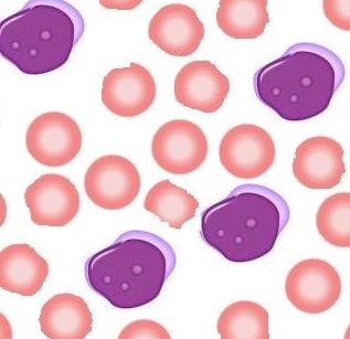 Schematic showing the appearance of acute myeloblastic leukemia under microscope