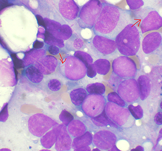 Bone marrow aspirate showing acute myeloid leukemia. Several blasts have Auer rods.