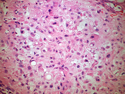 Bone Chordoma