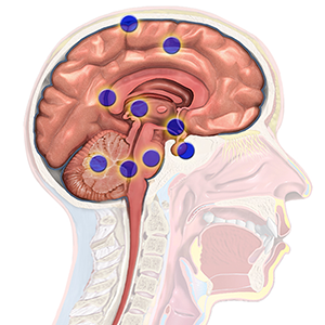 Brain cancer regions.