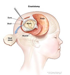 Craniotomy