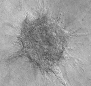 Human breast tumor organoid invades collectively into a 3D collagen I microenvironment