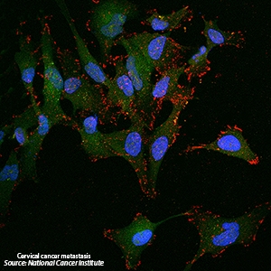 Cervical Cancer Metastasis