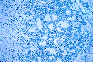 A 40x image of a typical neuroblastoma with rosette formation. Image credit: Dr. Maria Tsokos, National Cancer Institute