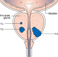 Diagram showing stages of prostate cancer