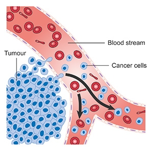 Diagram showing cancer cells spreading into the blood stream CRUK 448