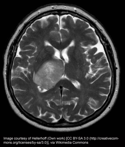 CAT scan image of GBM 