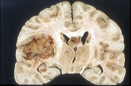 Glioblastoma macro