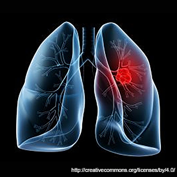 Image of KRAS-Positive Lung Cancer