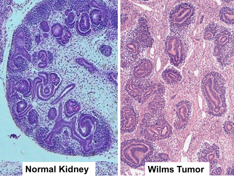 Image of normal and cancerous kidney tissue
