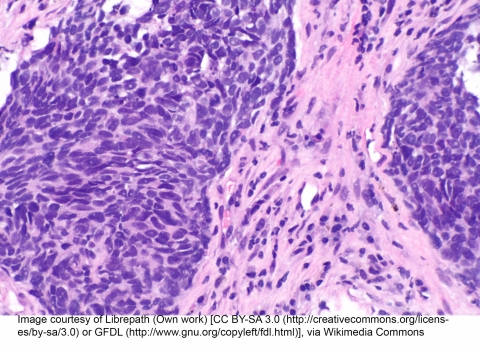 H&E non small cell lung cancer