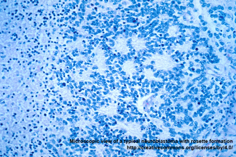 Microscopic view of a typical neuroblastoma with rosette formation