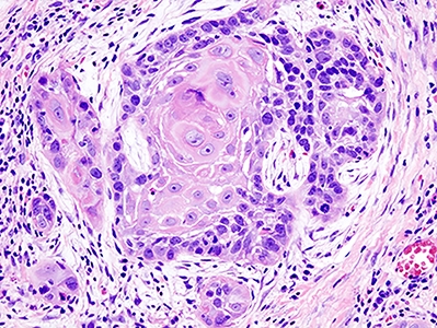 Histopathologic image illustrating well differentiated squamous cell carcinoma in the excisional biopsy specimen. Hematoxylin-eosin stain.