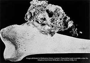 Image of Osteosarcoma in a human bone
