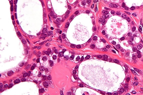 Micrograph of ovarian clear cell carcinoma from Wikimedia Commons