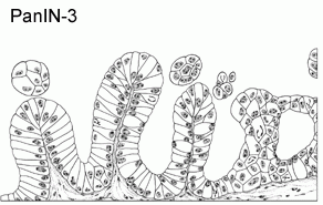 Illustration of pancreatic cancer