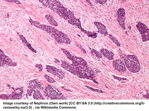 H&E image of Pancreatic cancer