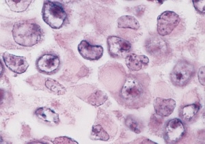 Pathology of rhabdoid tumor