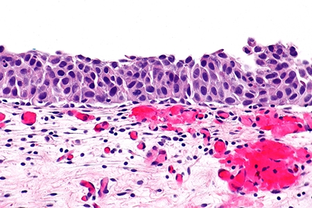 Urothelial carcinoma in situ