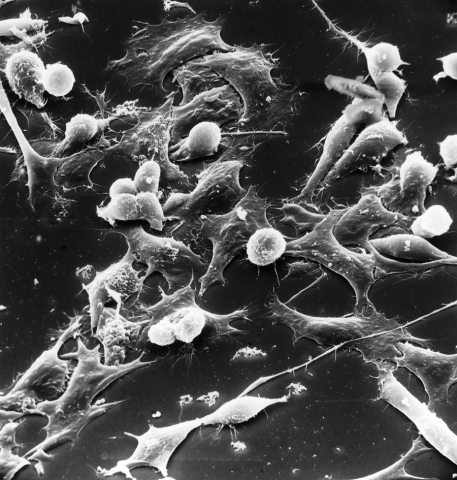 Scanning electron microscopy of Wilms tumor 
