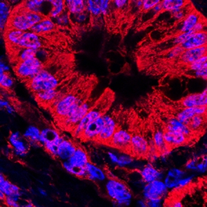 Mitochondrial Dynamics in Pancreatic Cancer