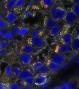 Heterogeneity in Triple-Negative Breast Cancer