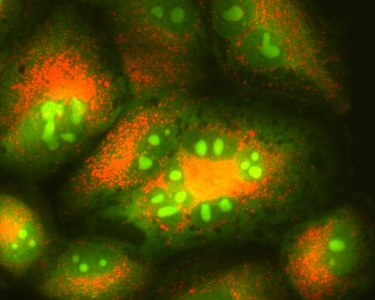 Lung Cancer Autophagy