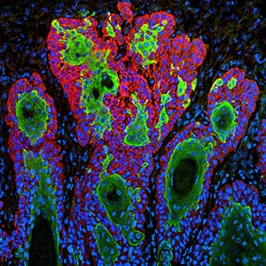 Skin Cancer Cells