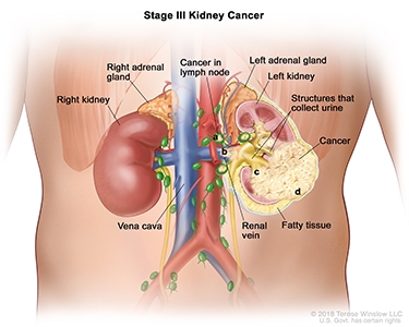 Kidney Cancer Stage III