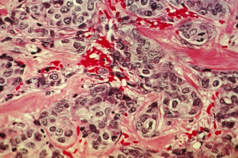 Hematoxylin and Eosin stained breast cancer tissue.