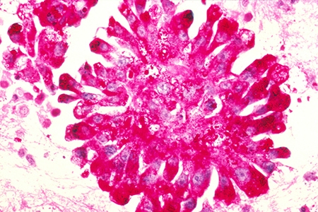 Ewing's Sarcoma (Source: Dr. Lance Liotta Laboratory)