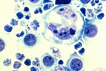 Human lymphoma tumor cells.