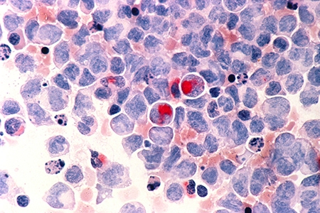 Leukemia (AML)
