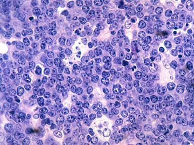 Malignant B-cell lymphocytes seen in Burkitt's lymphoma, stained with hematoxylin and eosin (H&E) stain.