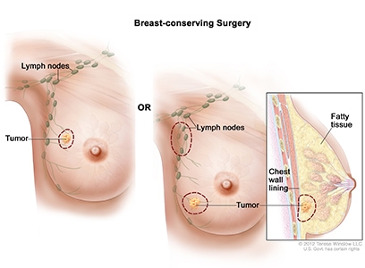 Surgery, Breast-Conserving, Female